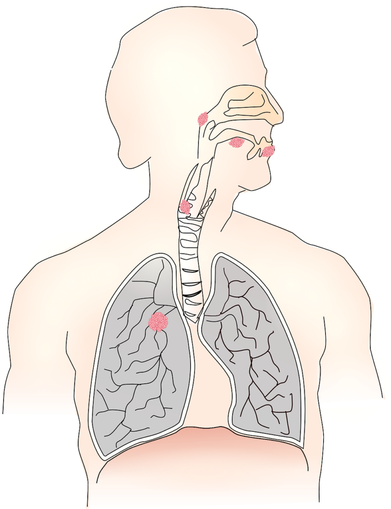 cancer, carcinoma, metastases-156101.jpg