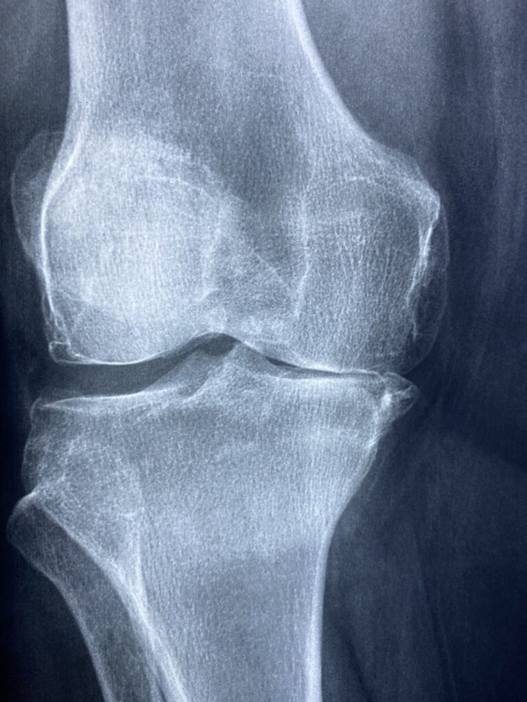 knee, x rays, arthritis-5314881.jpg